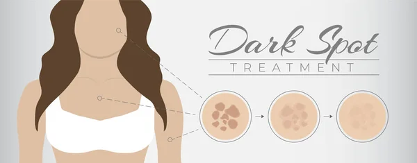 Projeto Ilustração Tratamento Ponto Escuro Com Pigmentação Pele Mulher Melasma — Vetor de Stock