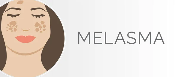 Melasma Skin Problem Background Diseño Ilustración Con Pigmentación Piel Mujer — Vector de stock