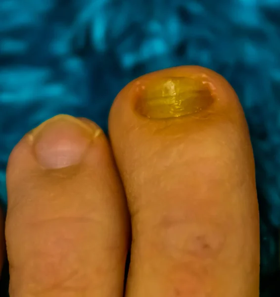 Закрыть Здоровый Грибок Инфицированных Ногтей Ног Распространенные Инфекции Ногтей Заболевания — стоковое фото