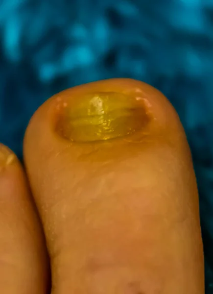 Макро Закрыть Грибок Инфицированных Ногтей Пальцев Ног Распространенных Инфекций Заболеваний — стоковое фото
