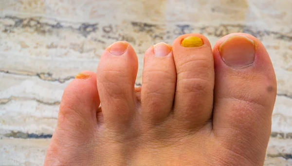 Пальцами Ног Вблизи Грибком Инфицированных Ногтей Общей Инфекции Заболеваний — стоковое фото