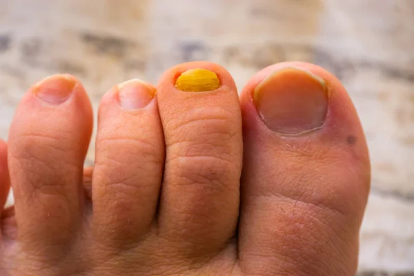 Закрыть Ногти Пальцев Ног Одним Грибком Инфицированных Ногтей Распространенных Заболеваний — стоковое фото