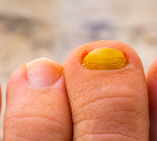 Крупный План Грибка Инфицированных Ногтей Сравнению Здоровым Ногтем Распространенных Заболеваний — стоковое фото