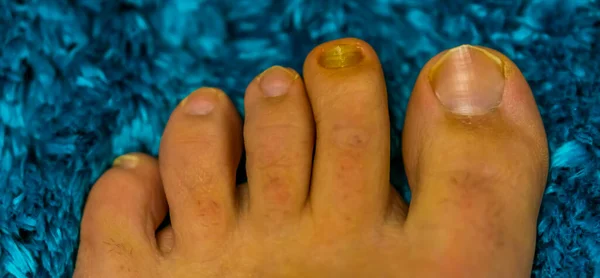 Dedos Los Pies Primer Plano Con Una Uña Infectada Por — Foto de Stock