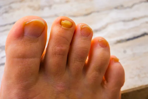 Closeup Feet One Fungus Infected Toe Nail — стоковое фото