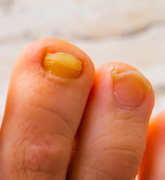 Closeup Fungus Infected Toe Nail Next Healty One Common Infections — стоковое фото
