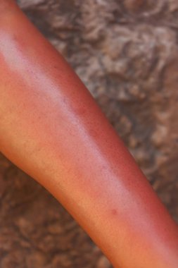 sunburn on human skin. red skin from the sun on the girl's leg. ultraviolet rays spoiled the skin of a young woman
