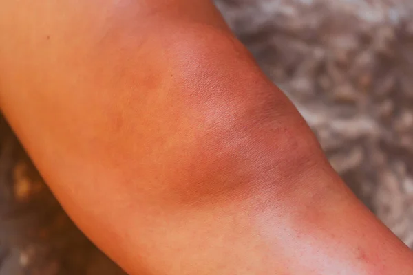 Sunburn Human Skin Red Skin Sun Girl Leg Ultraviolet Rays — Fotografie, imagine de stoc