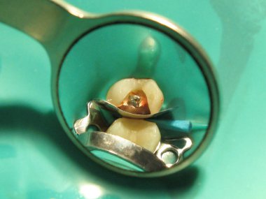 Diş hekiminde deliği olan bir diş tedavisi. İnsanın ağzında içten çürümüş bir diş. İhmal edilmiş bir dişin tedavisi için bir prosedür