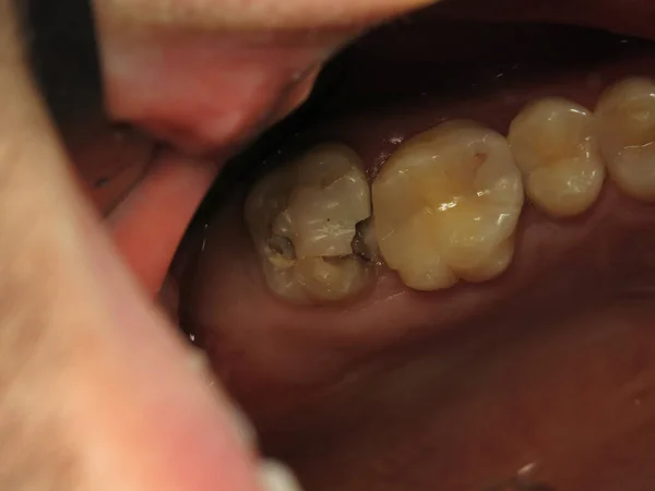 歯医者での歯科治療 問題のある歯を埋める プロの歯科医の仕事は — ストック写真