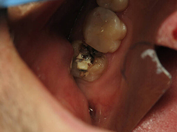 стоматологическое лечение у дантиста. заполнение проблемных зубов. работа профессионального стоматолога