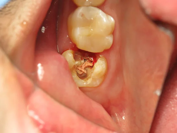 treatment of a tooth with a hole at the dentist. a decayed tooth from the inside in a person\'s mouth. a procedure for treating a neglected tooth