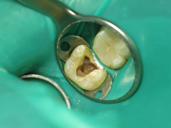Tratamiento Diente Con Orificio Dentista Una Caries Dental Desde Interior — Foto de Stock
