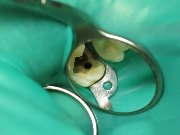 лечение зуба с отверстием у стоматолога. гнилой зуб изнутри во рту человека. процедура лечения забытого зуба