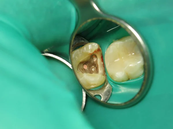 treatment of a tooth with a hole at the dentist. a decayed tooth from the inside in a person\'s mouth. a procedure for treating a neglected tooth