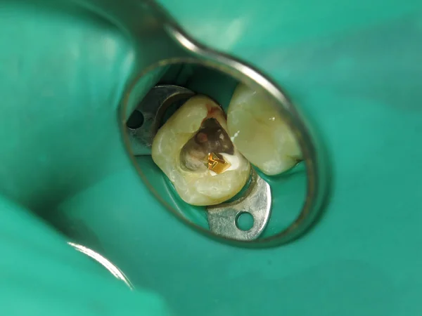 treatment of a tooth with a hole at the dentist. a decayed tooth from the inside in a person\'s mouth. a procedure for treating a neglected tooth