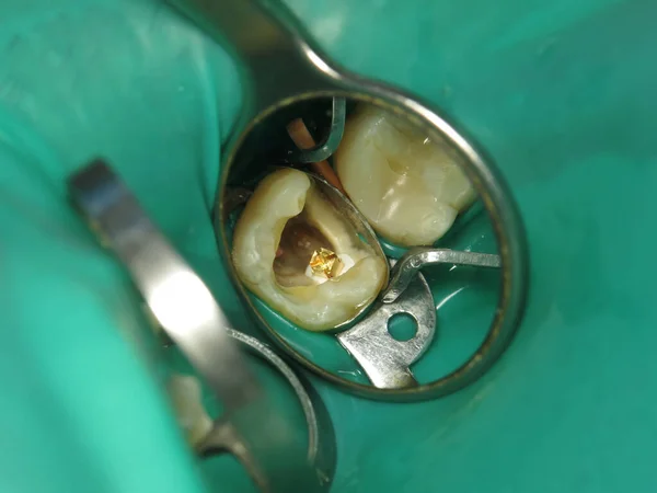 treatment of a tooth with a hole at the dentist. a decayed tooth from the inside in a person\'s mouth. a procedure for treating a neglected tooth