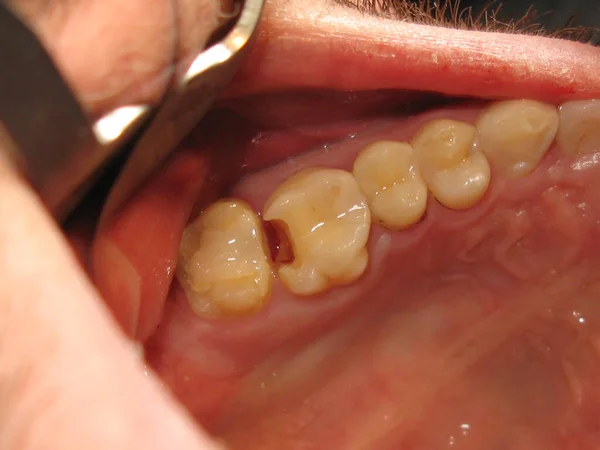 treatment of a tooth with a hole at the dentist. a decayed tooth from the inside in a person\'s mouth. a procedure for treating a neglected tooth