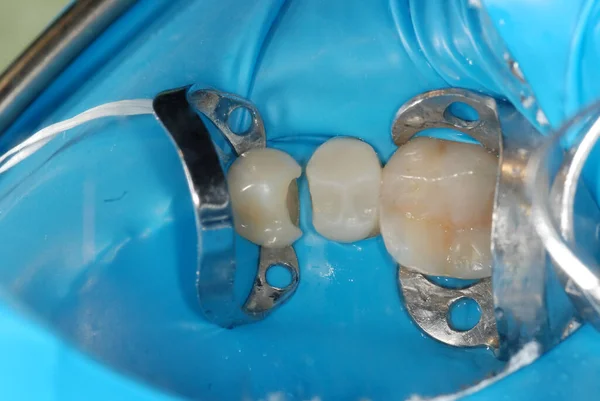 treatment of a tooth with a hole at the dentist. a decayed tooth from the inside in a person's mouth. a procedure for treating a neglected tooth