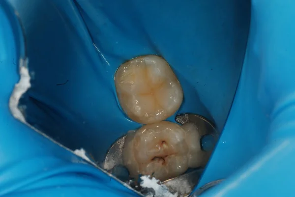歯医者での歯科治療 問題のある歯を埋める 滴から保護するためにガムの上に特別な弾性パッド 歯の上のコファダム — ストック写真