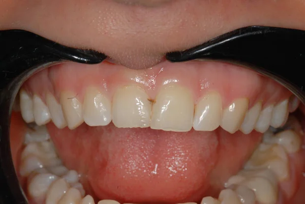 dental treatment at the dentist. filling problematic teeth. work of a professional dentist