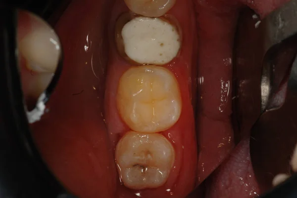 牙医的牙科治疗 填补有问题的牙齿 专业牙医的工作 — 图库照片