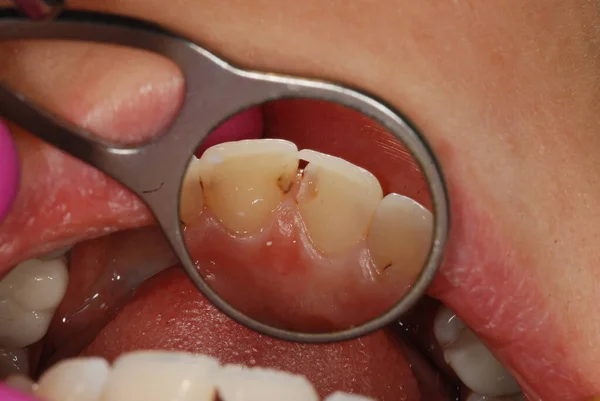 Traitement Dentaire Chez Dentiste Remplissage Des Dents Problématiques Travail Dentiste — Photo