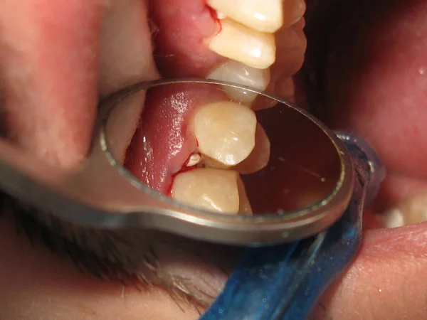 Traitement Dentaire Chez Dentiste Remplissage Des Dents Problématiques Travail Dentiste — Photo