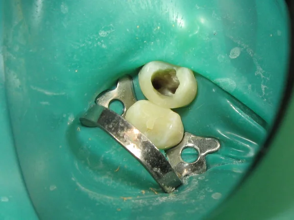 用牙洞治疗牙齿的方法 从一个人嘴里从里面钻出的一颗腐烂的牙 治疗被忽视的牙齿的程序 — 图库照片