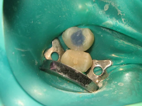 treatment of a tooth with a hole at the dentist. a decayed tooth from the inside in a person\'s mouth. a procedure for treating a neglected tooth