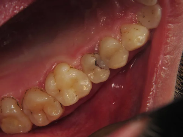 Traitement Une Dent Avec Trou Chez Dentiste Une Dent Cariée — Photo