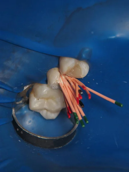 用牙洞治疗牙齿的方法 从一个人嘴里从里面钻出的一颗腐烂的牙 治疗被忽视的牙齿的程序 — 图库照片