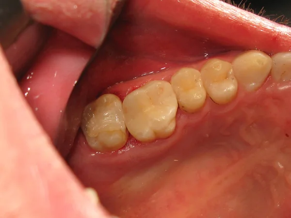 Traitement Dentaire Chez Dentiste Remplissage Des Dents Problématiques Travail Dentiste — Photo