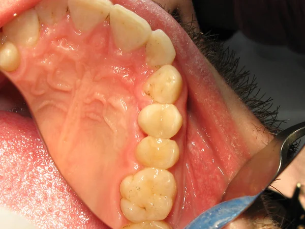 Traitement Dentaire Chez Dentiste Remplissage Des Dents Problématiques Travail Dentiste — Photo