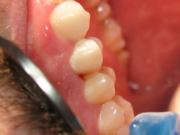 Traitement Dentaire Chez Dentiste Remplissage Des Dents Problématiques Travail Dentiste — Photo