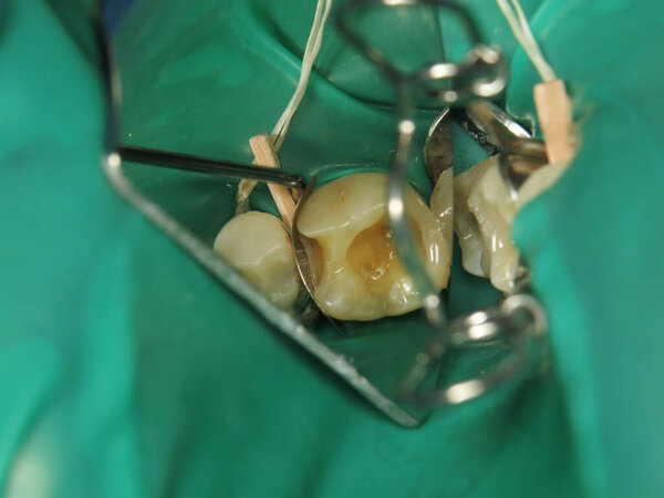 лечение зуба с отверстием у стоматолога. гнилой зуб изнутри во рту человека. процедура лечения забытого зуба