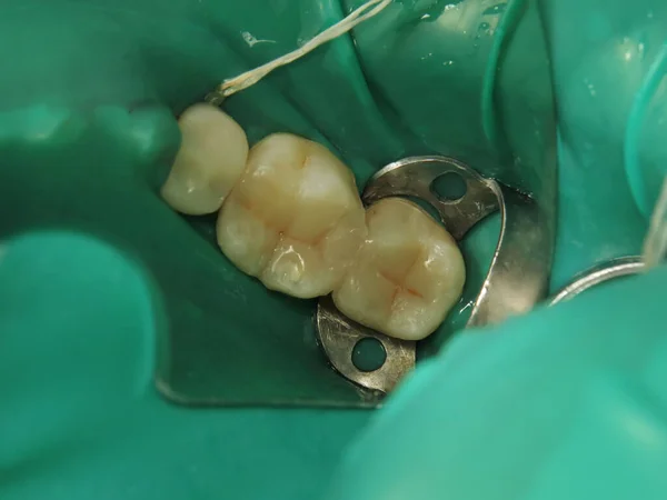 牙医的牙科治疗 填补有问题的牙齿 牙龈上有特殊的弹性垫 以防止滴落 牙齿上的围堰 — 图库照片