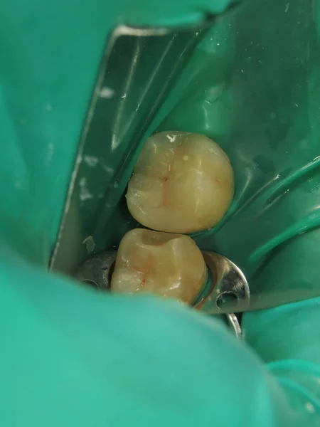 treatment of a tooth with a hole at the dentist. a decayed tooth from the inside in a person\'s mouth. a procedure for treating a neglected tooth