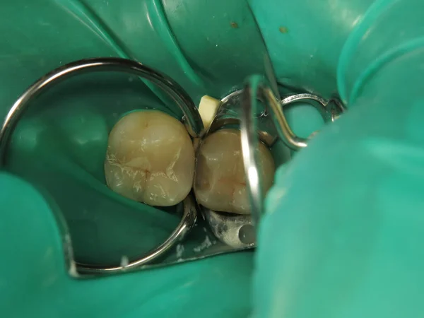 Tratamiento Dental Dentista Llenando Dientes Problemáticos Almohadilla Elástica Especial Las — Foto de Stock