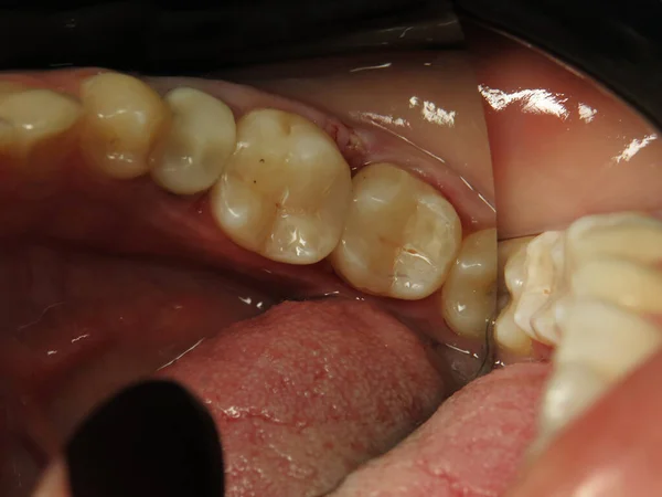 Traitement Dentaire Chez Dentiste Remplissage Des Dents Problématiques Travail Dentiste — Photo