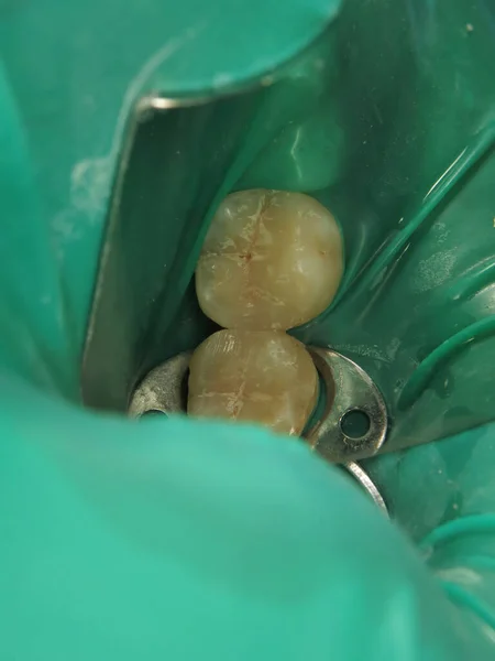 歯医者での歯科治療 問題のある歯を埋める 滴から保護するためにガムの上に特別な弾性パッド 歯の上のコファダム — ストック写真