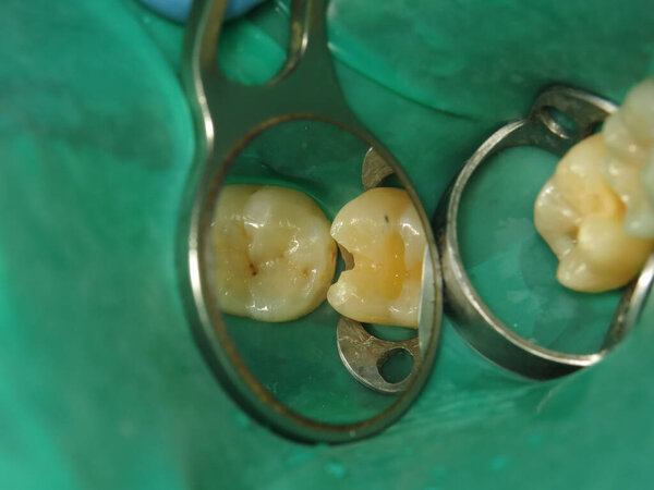 лечение зуба с отверстием у стоматолога. гнилой зуб изнутри во рту человека. процедура лечения забытого зуба