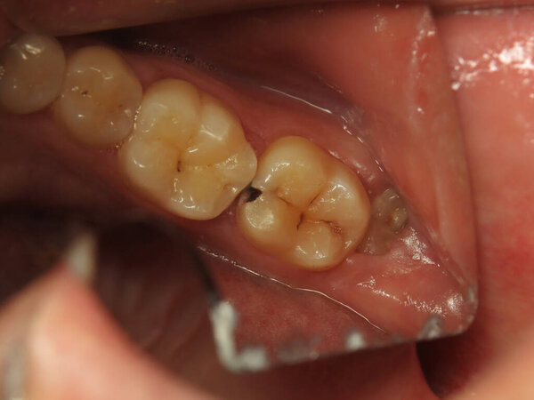 стоматологическое лечение у дантиста. заполнение проблемных зубов. работа профессионального стоматолога
