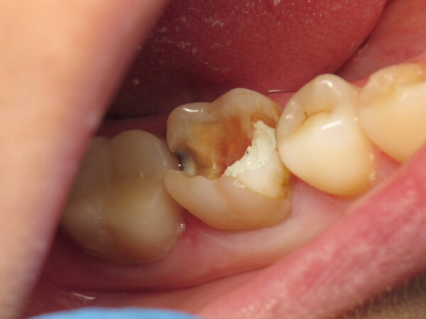 лечение зуба с отверстием у стоматолога. гнилой зуб изнутри во рту человека. процедура лечения забытого зуба