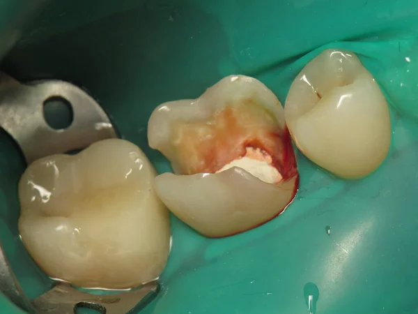 treatment of a tooth with a hole at the dentist. a decayed tooth from the inside in a person\'s mouth. a procedure for treating a neglected tooth