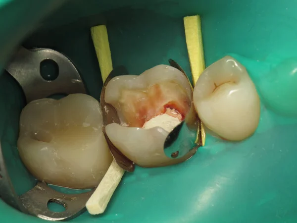歯医者の穴のある歯の治療 人の口の中から虫歯になった歯です 放置歯の治療方法 — ストック写真