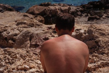 Hindiyle tatile çıkmış, güneşten kızarmış derili bir adam. Antalya 'da güneş yanığı yüzünden cildinde yanıklar olan bir adam. İnsan tehlikeli bir saatte bronzlaşır.