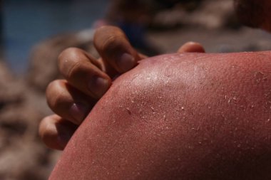 Hindiyle tatile çıkmış, güneşten kızarmış derili bir adam. Antalya 'da güneş yanığı yüzünden cildinde yanıklar olan bir adam. İnsan tehlikeli bir saatte bronzlaşır.