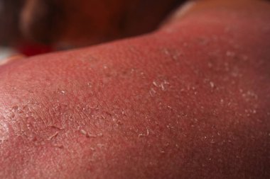 Bir adamın derisinde güneş yanığı. Çocuğun omzundaki kabarcıklar yüzünden şişmiş deri. Kırmızı derili, güneşin bol olduğu bir yer. Tehlikeli bir saatte güneş yanığı