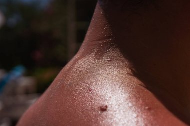 Bir adamın derisinde güneş yanığı. Çocuğun omzundaki kabarcıklar yüzünden şişmiş deri. Kırmızı cilde koruyucu krem sürüyorum. Tehlikeli bir güneş ışığı saatinde deriyi korumak için beyaz krem.